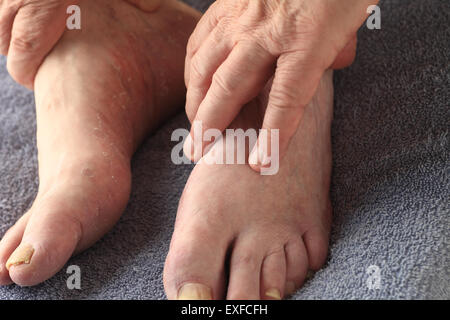 A man's hands on his feet, one of which has both toenail fungus and the dry, peeling skin of athletes foot Stock Photo
