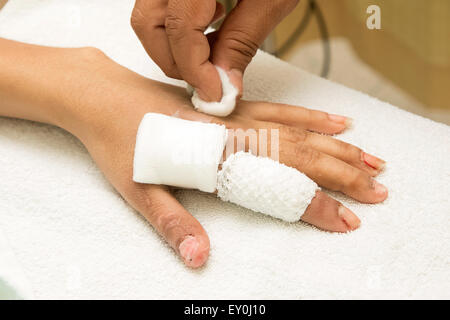 injured finger wrapped in a gauze bandage after surgery Stock Photo