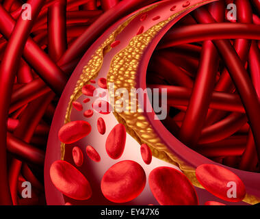 Artery problem with clogged arteries and atherosclerosis disease medical concept with a three dimensional human cardiovascular system with blood cells that blocked by plaque buildup of cholesterol as a symbol of vascular diseases. Stock Photo