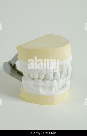 A dental study cast of upper and lower jaws. The cast is a positive reproduction of teeth and surrounding structures for the purpose of study and treatment planning created by pouring to allow an impression in plaster or stone. Stock Photo