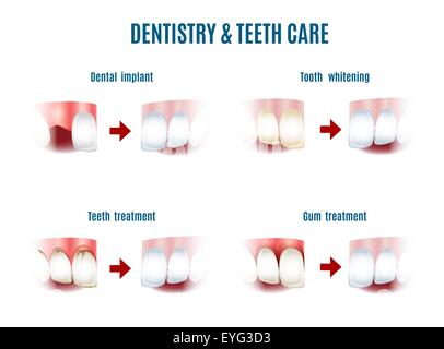 Dentistry treatment and main teeth care procedures. Implants, whitening, gum and oral cavity. Free font Antonio used. Isolated Stock Vector