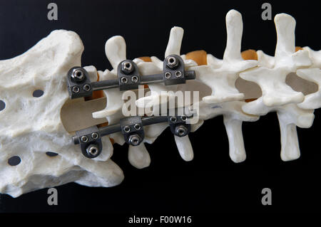 Orthopedic Institute Galeazzi (Milan, Italy), prosthesis for the vertebral column Stock Photo