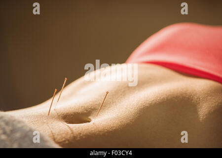 Young woman getting acupuncture treatment Stock Photo