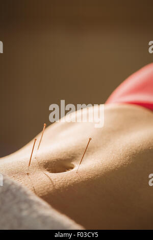 Young woman getting acupuncture treatment Stock Photo