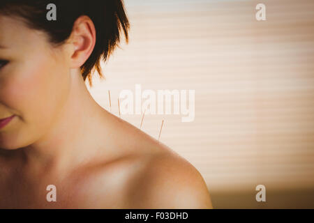 Young woman getting acupuncture treatment Stock Photo