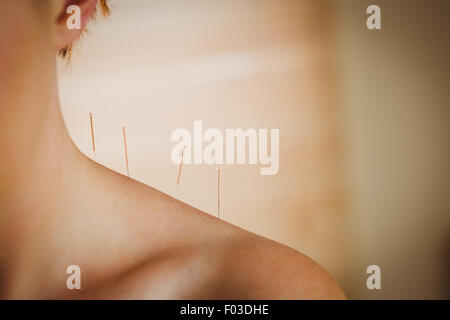 Young woman getting acupuncture treatment Stock Photo