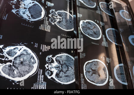 Multi radiography of the brain. Guadalajara, Jalisco. Mexico Stock Photo