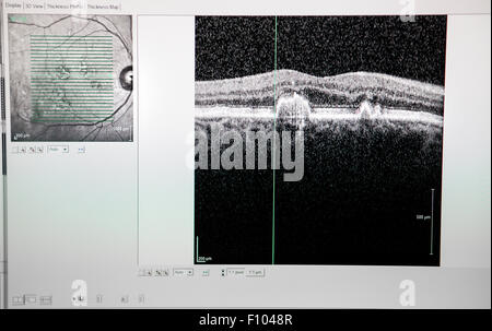 MACULAR DEGENERATION Stock Photo