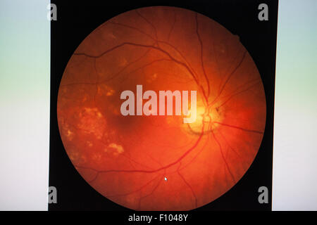 FUNDUS OCULI Stock Photo