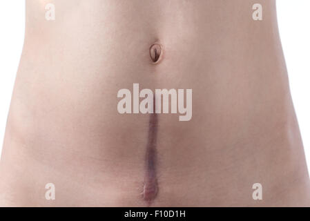A woman's scar from a c-section birth on a white background. Stock Photo