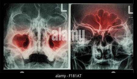 Film X-ray paranasal sinus : show sinusitis at maxillary sinus ( left image ) , frontal sinus ( right image ) Stock Photo