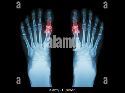 Gout , Rheumatoid arthritis ( Film x-ray both foot and arthritis at first metatarsophalangeal joint ) ( Medicine and Science bac Stock Photo