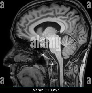 MRI scan, T1 weighted, sagittal view through the brain of a 54 year old ...