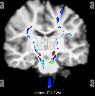 Coronal view human brain Parkinson's disease. Blue/green areas highlight fibers motor system red area is substancia nigra Stock Photo