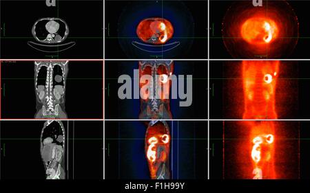 Image co-registered PET-CT study dual modality scanner. Patient multiple metastatic lesions liver & lung Stock Photo