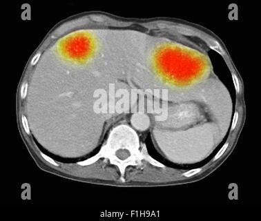 Image co-registered PET-CT study dual modality scanner. Patient multiple metastatic lesions liver & lung Stock Photo