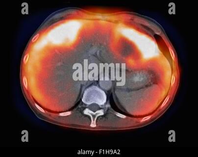 Image co-registered PET-CT study dual modality scanner. Patient multiple metastatic lesions liver & lung Stock Photo