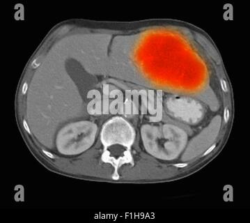 Image co-registered PET-CT study dual modality scanner. Patient multiple metastatic lesions liver & lung Stock Photo