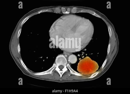 Image co-registered PET-CT study dual modality scanner. Patient multiple metastatic lesions liver & lung Stock Photo