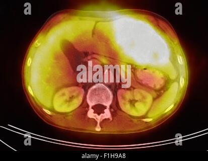 Image co-registered PET-CT study dual modality scanner. Patient multiple metastatic lesions liver & lung Stock Photo