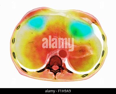 Image co-registered PET-CT study dual modality scanner. Patient multiple metastatic lesions liver & lung Stock Photo