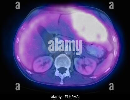 Image co-registered PET-CT study dual modality scanner. Patient multiple metastatic lesions liver & lung Stock Photo