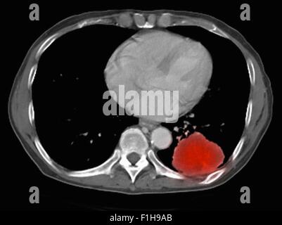 Image co-registered PET-CT study dual modality scanner. Patient multiple metastatic lesions liver & lung Stock Photo