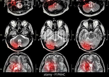 Film MRI ( Magnetic resonance imaging ) of brain ( This MRI of brain is normal brain but red color area is artificially for assu Stock Photo