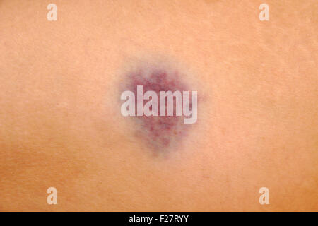 Close up on a bruise on wounded woman leg skin. Gender violence concept Stock Photo