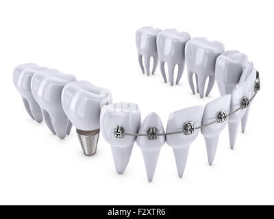 a teeth with braces and dental implants Stock Photo