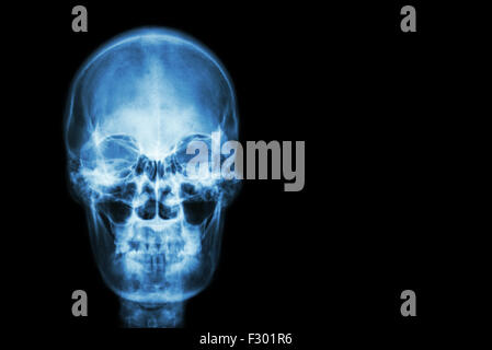 film x-ray skull of human and blank area at right side ( Medical , Science and Healthcare concept and background ) Stock Photo