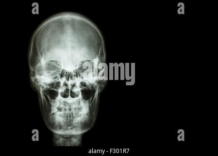 film x-ray skull of human and blank area at right side ( Medical , Science and Healthcare concept and background ) Stock Photo