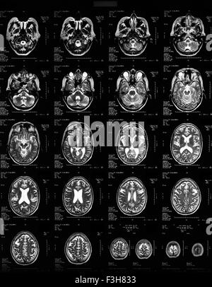 Normal MRI of the brain of a 62 year old woman Stock Photo - Alamy
