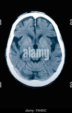 CT scan 84 year old male with Alzheimer's disease.  CT shows brain atrophy with small gyri and large sulci Stock Photo