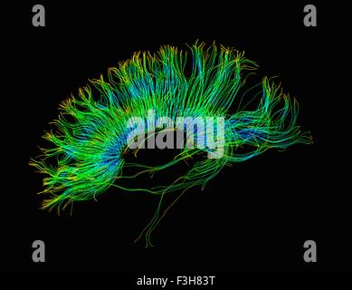 Diffusion tensor imaging (DTI) scan. Shown are the reconstructed white ...