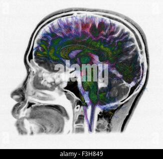 Diffusion MRI, also referred to as diffusion tensor imaging or DTI, of the human brain Stock Photo