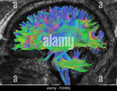 Diffusion MRI, also referred to as diffusion tensor imaging or DTI, of the human brain Stock Photo