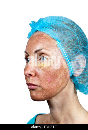 Cosmetology. New skin after a chemical peeling, a redness because of too fast deleting an old layer. Stock Photo