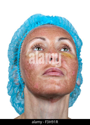 Cosmetology. New skin after a chemical peeling, a redness because of too fast deleting an old layer. Stock Photo