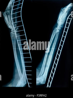 X-Ray image of human hand and arm after a fracture on the metal support. Medical examination Stock Photo