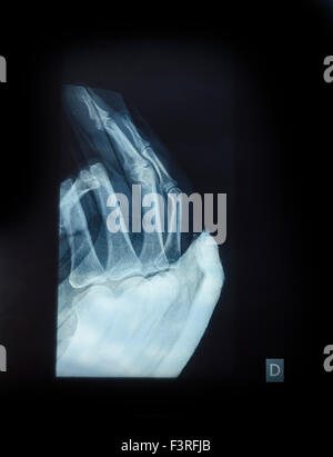 X-Ray image of human hand for fracture Stock Photo