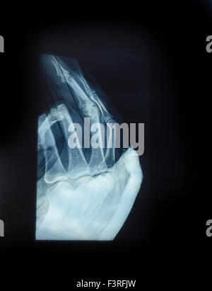 X-Ray image of human hand for fracture Stock Photo