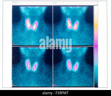 Thyroid Gland Scintigraphy Stock Photo - Alamy