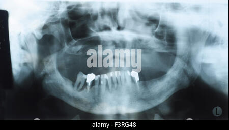Panoramic dental x-ray of an old person with some lower teeth and no tooth of the upper. No selections Stock Photo