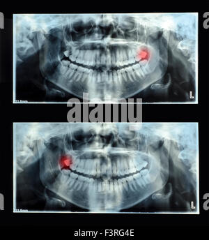 Panoramic dental x-ray  with superior upper wisdom tooth (eight tooth) shown red. Double x-ray Stock Photo