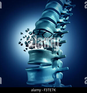 Spinal Fracture and traumatic vertebral injury medical concept as a human anatomy spinal column with a broken burst vertebra due to compression or other osteoporosis back disease. Stock Photo