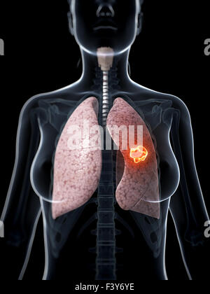 3d rendered illustration of lung cancer Stock Photo - Alamy