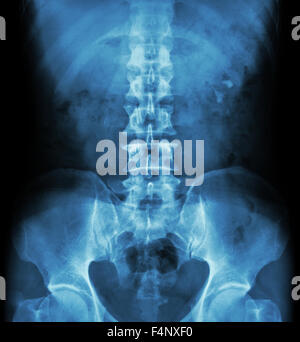 Kidney stone ( renal stone , renal calculi ) ( film x-ray KUB Stock