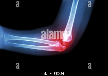 Rheumatoid arthritis , Gouty arthritis ( film x-ray child 's elbow with arthritis at elbow ) ( Side view , Lateral ) Stock Photo