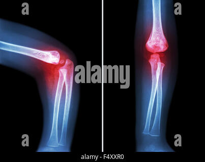 Rheumatoid arthritis , Gouty arthritis ( film x-ray child 's elbow with arthritis at elbow ) ( Side and front view , Lateral and Stock Photo